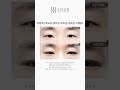 [B&amp;A] 비절개눈매교정+윗트임+뒤트임+밑트임 3개월차