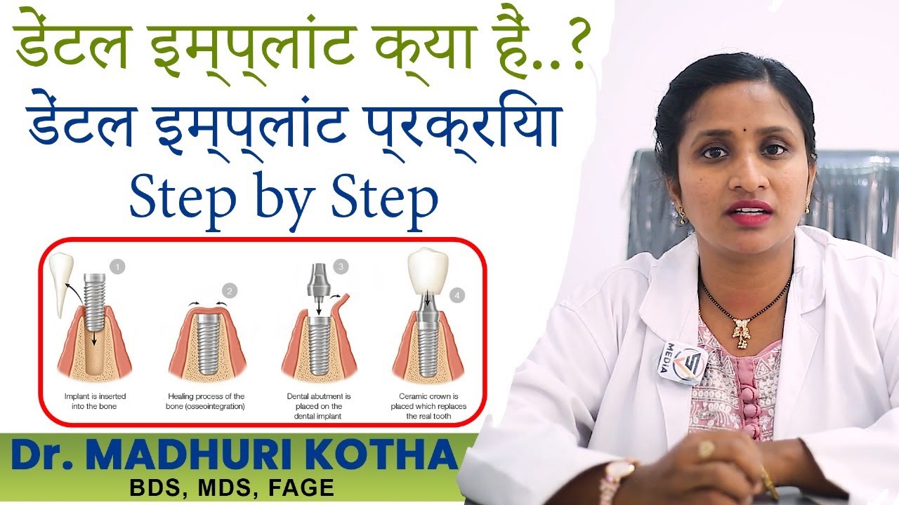 What are Dental Implants & Procedure Explained Step by Step in Hindi Dr. Madhuri k Oxy