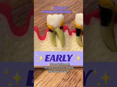 Stages Of Periodontal Disease This Month Is Dental Hygiene Health 