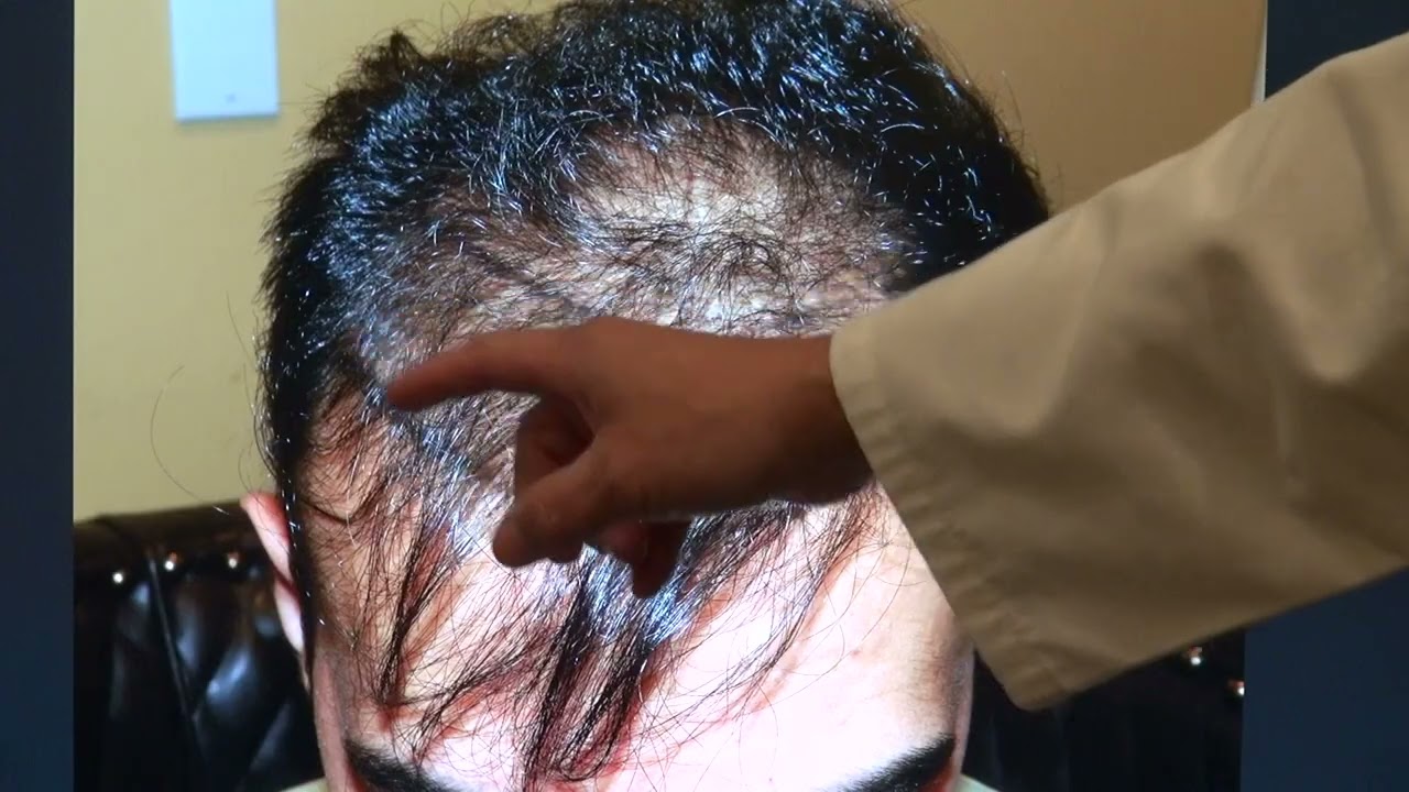 Hair Loss Treatment for Men | [Type of transplant] (# Hair grafts)