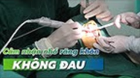 Nhổ 2 răng khôn mọc lệch 90 độ có đau không?