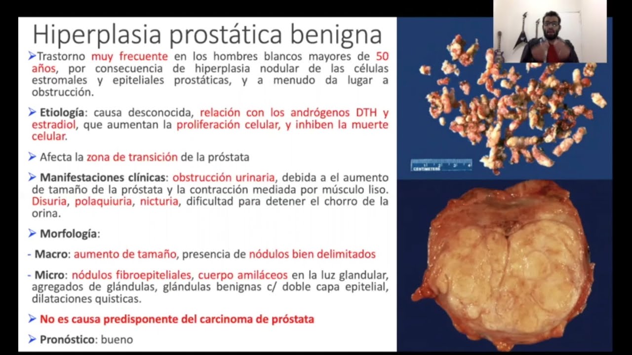 cáncer de próstata anatomía patológica tratamentul prostatitei odenomului