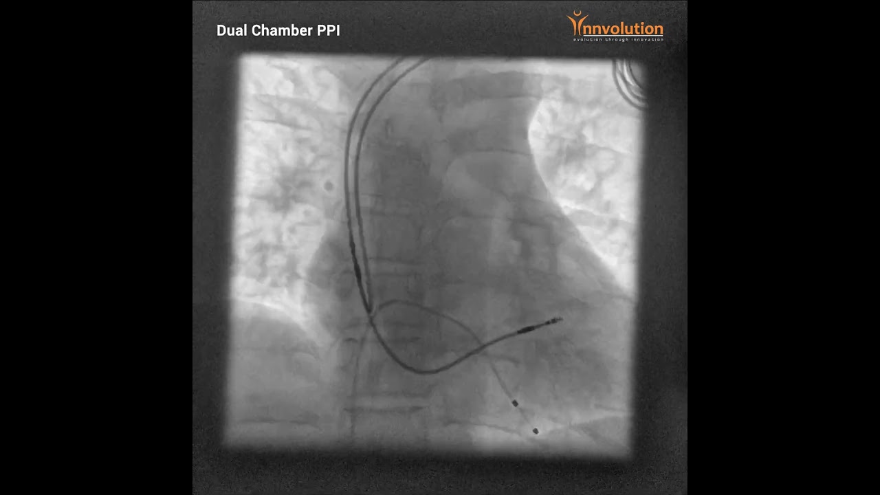 Dual Chamber PPI
