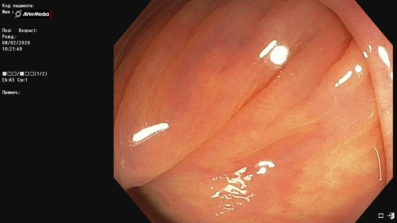 Трудная интубация толстой кишки (долихоколон)