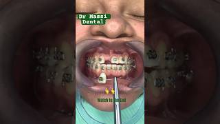 Dental Braces Invisalign Viral Orthodontics