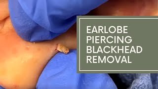 Earlobe Piercing Blackhead Removal | DrDerm