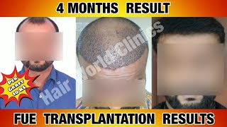 4Months Completed Best Results Before And After Hair Transplant Results Hair World Clinics
