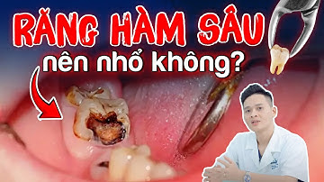 Răng Hàm Bị Sâu Có Nên Nhổ Không? Đừng Vội Nhổ Bỏ, Xem Ngay Video Trước Khi Quyết Định!