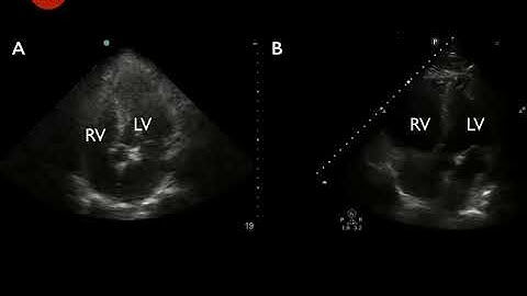 Video 7   Apical 4 chamber views with normal and abnormal Right ventricle