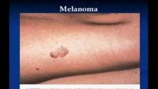 Chapter 9 - BRCH Lecture Series on Dermatology