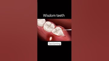 “Easy Impacted Wisdom Tooth Removal – No Stress!”#wisdom