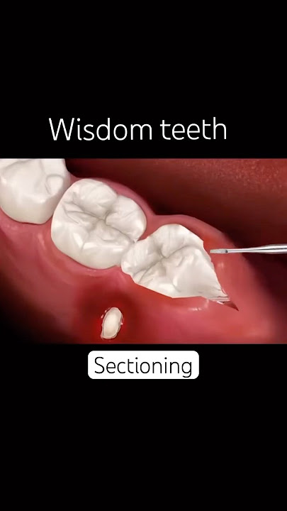 “Easy Impacted Wisdom Tooth Removal – No Stress!”#wisdom
