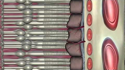 Laser Therapy for Wet AMD