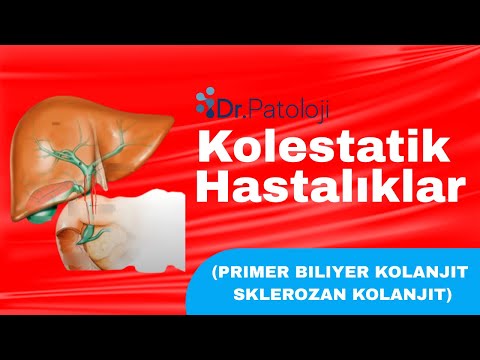 Her TUS soru gelen bir konu. Kolestatik Hastalıklar (Primer Biliyer Kolanjit- Sklerozan Kolanjit)