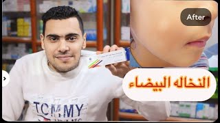 روشتة علاج النخاله البيضاء | البقع البيضاء في وجه الأطفال | الفرق بين النخالة الوردية والبيضا |السبب