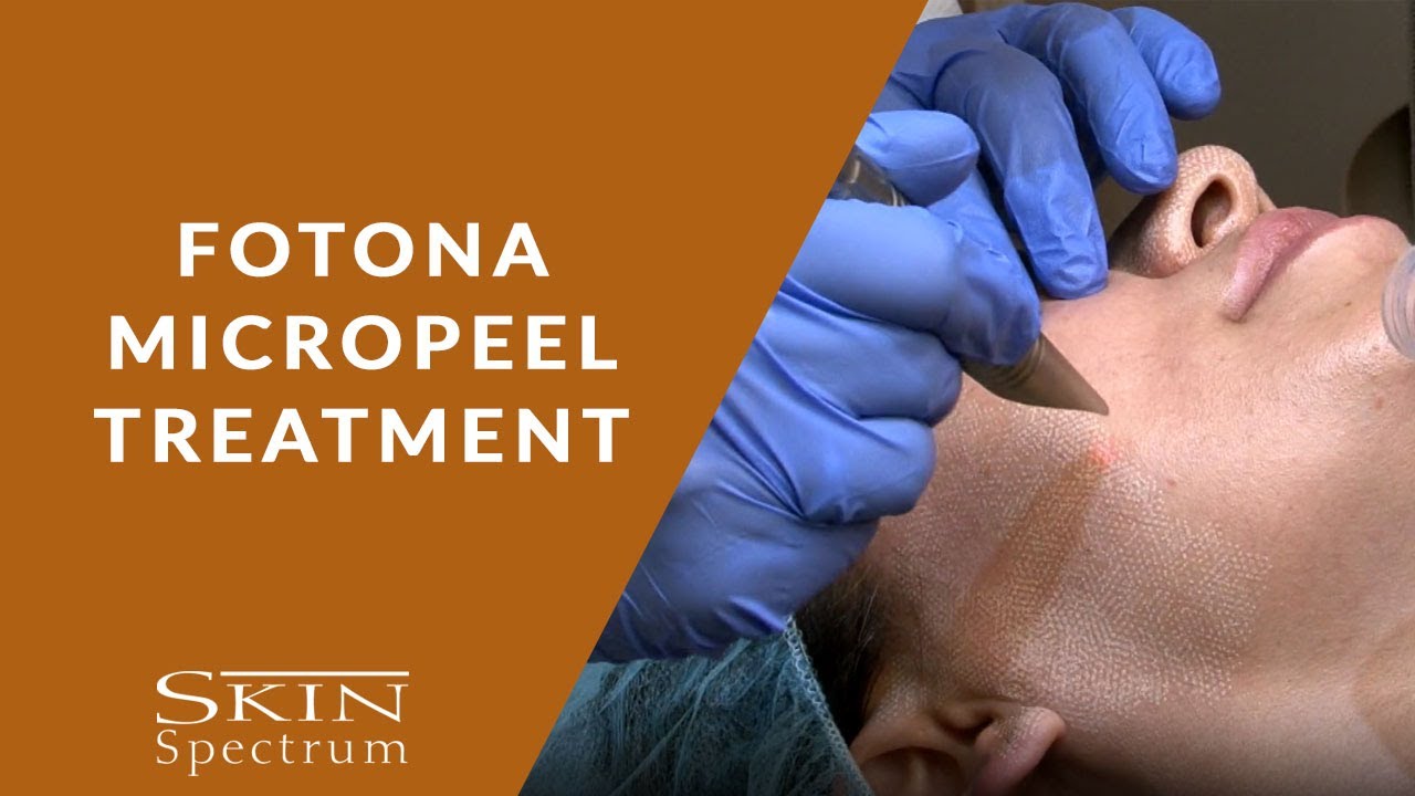 Fotona Mirco Peel Treatment