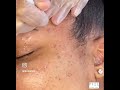 Dermatosis Papulosa Nigra aka  DPN Removal