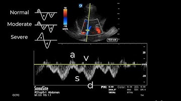 How to... Obtain a Hepatic Vein Waveform