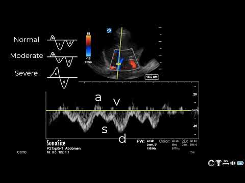 How to... Obtain a Hepatic Vein Waveform