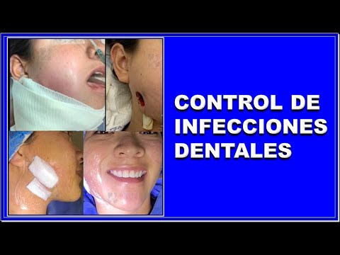 Vídeo: Infecció De Les Vies Respiratòries Superiors A Les Xinxilles