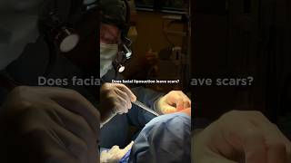 Does Facial Liposuction leave SCARS?orlando facialplasticsurgeon plasticsurgeon