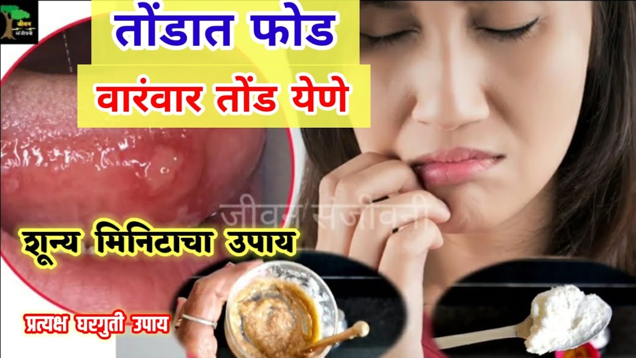 तोंडात फोड , वारंवार तोंड येणे , शून्य मिनिटाचा उपाय ! Tond yene