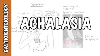 Achalasia (esophageal)  signs and symptoms, pathophysiology, investigations and treatment