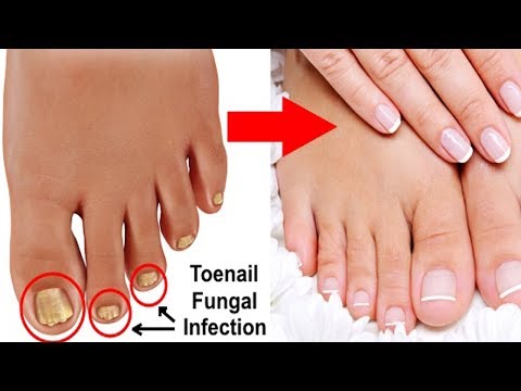 3-simple-and-effective-natural-cures-for-toenail-fungus