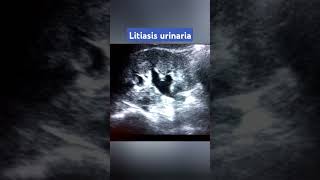 URETEROLITIASIS DOLOR RENAL