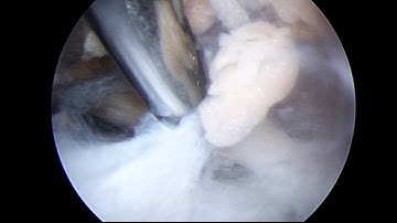 Suprascapular Nerve Decompression Case - Part 3