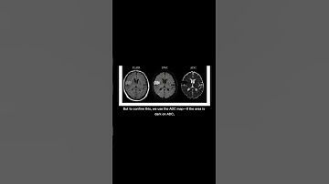 What does a stroke look like on a brain?DWI and ADC sequence #mri