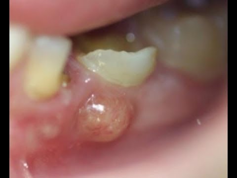 Vidéo: Kyste Dentaire: Traitement, élimination, Conséquences, Causes