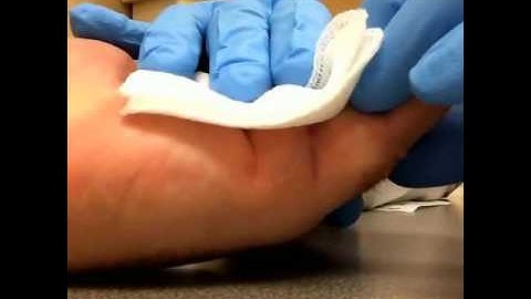 Slow motion Dupuytrens Xiaflex Cord Breaks