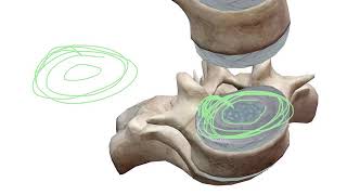 Disc Herniation - What is a Disc Protrusion vs Disc Extrusion?