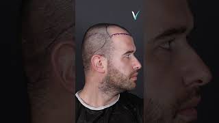 1 Year Hair Transplant Turkey Before After #shorts #hairtransplantturkeyresult #hairtransplantturkey