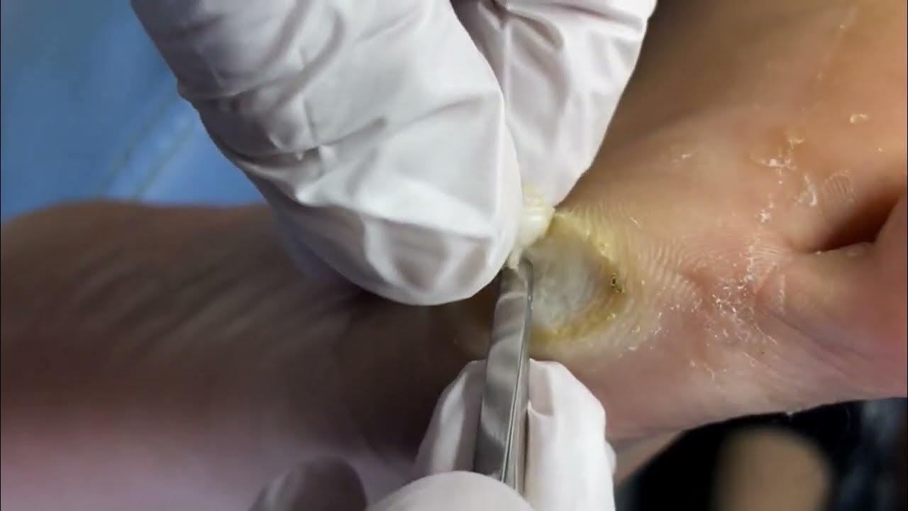 wart point of view foot treatment feet sac worry jigger YouTube