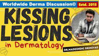 KISSING LESIONS in Dermatology | RESIDENTS PAGE | Journal IJDVL | Dr Maddineni Srinivas |
