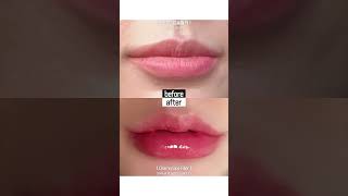 얇고 쭈글쭈글하던 입술에, 자연스러움을 채우다 [드라마 입술필러]🍀 #shorts