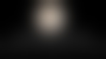 Posterolateral PUJ obstruction Laparoscopic Pyeloplasty | Tips and Tricks