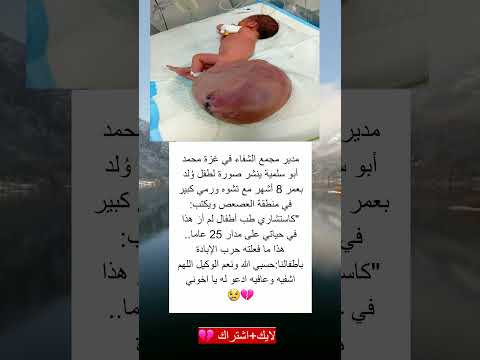 مدير مجمع الشفاء في غزة محمد أبو سلمية ينشر صورة لطفل و لد بعمر 8 أشهر مع تشوه ورمي كبير في منطقة