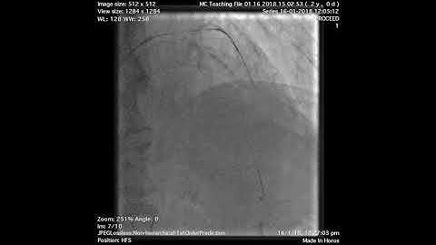 Left Main Stem to LAD/LCx Culotte Bifurcation PCI- Step by step approach