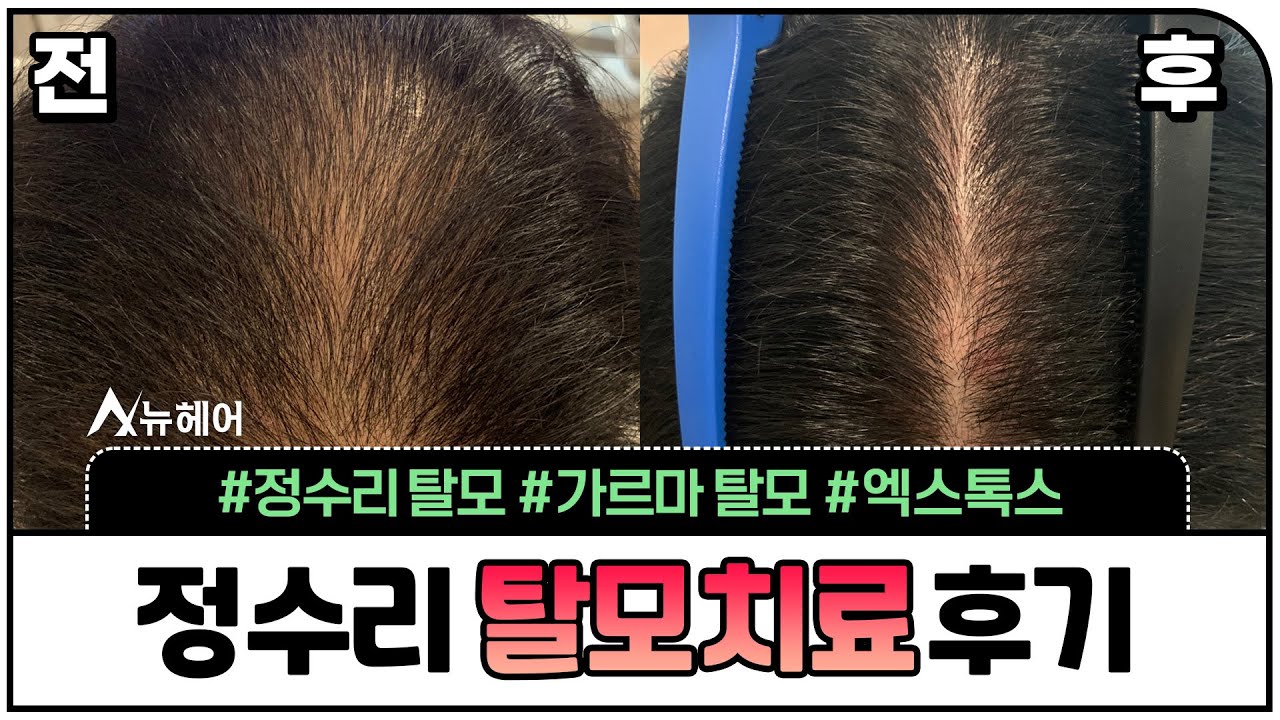 정수리탈모 가르마탈모 탈모치료 후기ㅣ뉴헤어