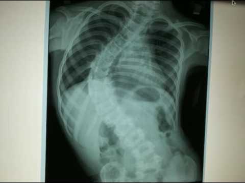 What U Of M Scoliosis Clinic