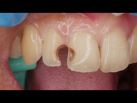 Video: Cara Merawat Tambal Gigi: 14 Langkah (dengan Gambar)
