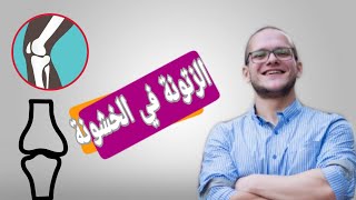 علاج خشونة الركبة - علاج طبيعي لخشونة الركبة