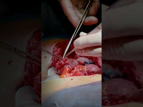 Wideo: 3 sposoby na opłacenie operacji plastycznej