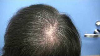 Dr Hasson Hair Transplant - 8800 grafts - 2 Sessions
