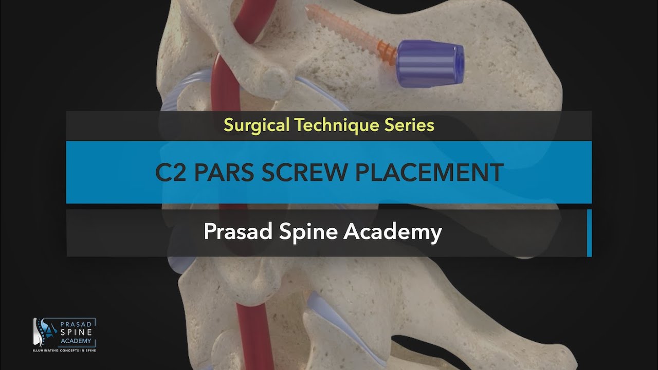 Surgical Techniques C2 Pars Screw Placement YouTube Surgical Techniques C2 Pars Screw Placement YouTube