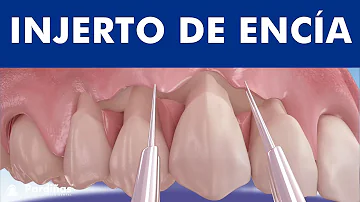 ¿Pueden crecer las encías sobre los implantes?