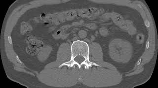 Quantitative computed tomography | Wikipedia audio article
